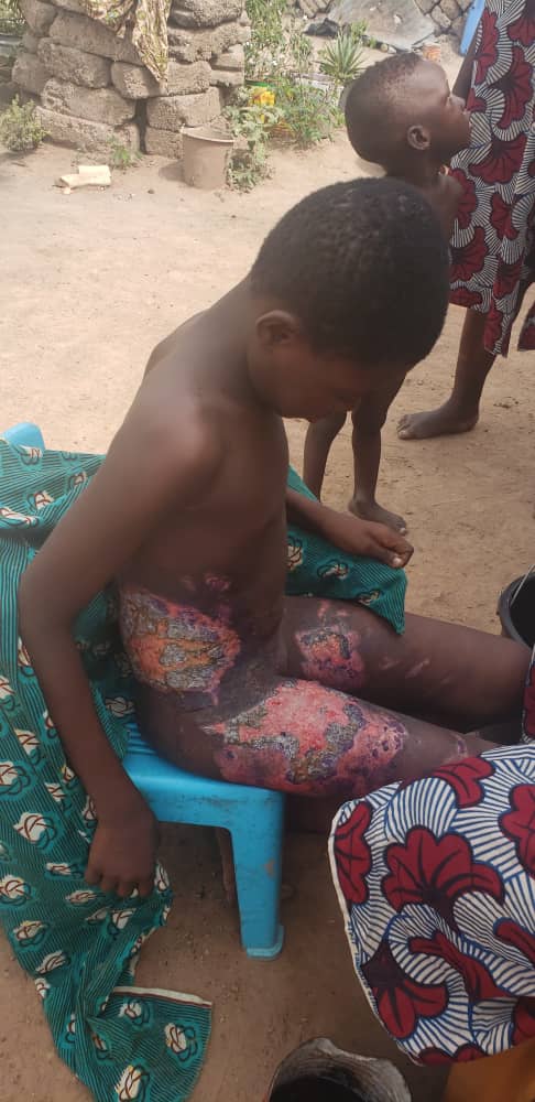Louisa (10J) aus Hohoe in Ghana erlitt schwere Verbrennungen